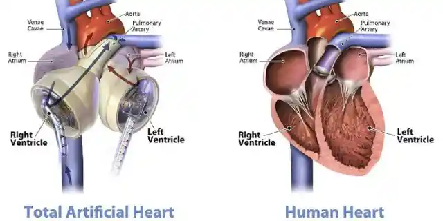 1982: Human Receives First Artificial Heart