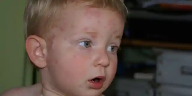 1974: The Chickenpox Vaccine