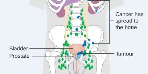 1966: Hormonal Treatment of Prostatic Cancer